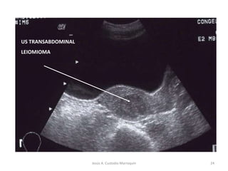US TRANSABDOMINAL
LEIOMIOMA
24Jesús A. Custodio Marroquín
 