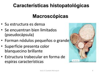Características histopatológicas
• Su estructura es densa
• Se encuentran bien limitados
(pseudocápsula)
• Forman nódulos pequeños o grandes
• Superficie presenta color
blanquecino brillante
• Estructura trabecular en forma de
espiras características
Macroscópicas
8Jesús A. Custodio Marroquín
 