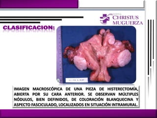 IMAGEN MACROSCÓPICA DE UNA PIEZA DE HISTERECTOMÍA,
ABIERTA POR SU CARA ANTERIOR. SE OBSERVAN MÚLTIPLES
NÓDULOS, BIEN DEFINIDOS, DE COLORACIÓN BLANQUECINA Y
ASPECTO FASCICULADO, LOCALIZADOS EN SITUACIÓN INTRAMURAL.
 