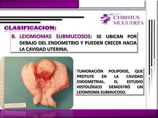 B. LEIOMIOMAS SUBMUCOSOS: SE UBICAN POR
  DEBAJO DEL ENDOMETRIO Y PUEDEN CRECER HACIA
  LA CAVIDAD UTERINA.



                       TUMORACIÓN POLIPOIDE, QUE
                       PROTUYE    EN   LA   CAVIDAD
                       ENDOMETRIAL.    EL   ESTUDIO
                       HISTOLÓGICO   DEMOSTRÓ    UN
                       LEIOMIOMA SUBMUCOSO.
 
