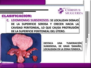 C. LEIOMIOMAS SUBSEROSOS: SE LOCALIZAN DEBAJO
  DE LA SUPERFICIE SEROSA Y CRECEN HACIA LA
  CAVIDAD PERITONEAL, LO QUE CAUSA PROTRUSIÓN
  DE LA SUPERFICIE PERITONEAL DEL ÚTERO.


                       DESTACA    UNA     TUMORACIÓN
                       SUBSEROSA, DE GRAN TAMAÑO,
                       LOCALIZADA EN LA ZONA FÚNDICA.
 