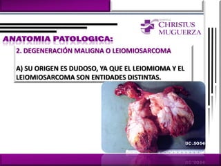 2. DEGENERACIÓN MALIGNA O LEIOMIOSARCOMA

A) SU ORIGEN ES DUDOSO, YA QUE EL LEIOMIOMA Y EL
LEIOMIOSARCOMA SON ENTIDADES DISTINTAS.
 