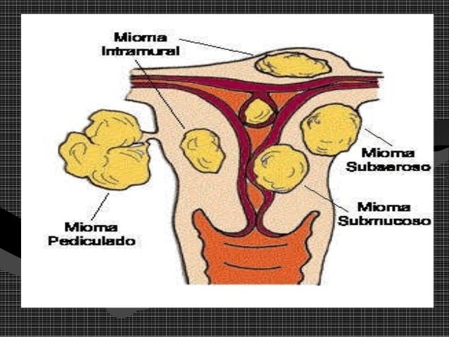 Leiomioma utero