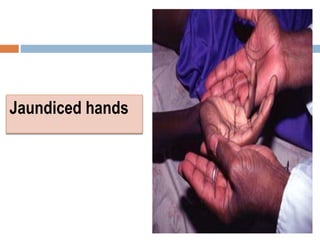Jaundiced hands
 