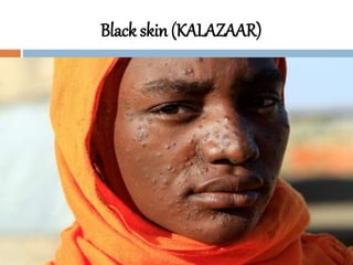 Black skin (KALAZAAR)
 