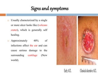 Signs and symptoms
 Usually characterized by a single
or more ulcer looks like (volcano
crater), which is generally self
healing.
 Approximately 40% of
infections affect the ear and can
cause serious damage to the
surrounding cartilage (New
world).
 
