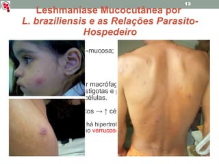 Conhecida como: Leishmaníase cutâneo-mucosa; Espúndia; Úlcera de Bauru; Ferida brava. Parasitos fagocitados por macrófagos da pele ( histiócitos ) transformam-se em amastigotas e permanecem no interior dos vacúolos -> rompem as células. Promovem ↑ dos histiócitos ->  ↑  células infectadas -> ↑ lesões. Nas lesões não-ulceradas, há hipertrofia do epitélio e um crescimento tecidual que pode ser de tipo  verrucoso  ou  papilomatoso  – várias formas clínicas diferentes. Leshmaníase Mucocutânea por  L. braziliensis e as Relações Parasito-Hospedeiro 
