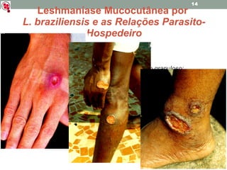 Leshmaníase Mucocutânea por  L. braziliensis e as Relações Parasito-Hospedeiro Lesão inicial: Papulo-vesiculoso -> Ulcerada; Ulcerada: Bordas salientes, talhadas a pique e com fundo granuloso; Pouco exsudativa e indolor; Lesão inicial, no local da picada, pode acompanhar-se de outras, de natureza metastática; Disseminação: lesão inicial, no local da picada, pode acompanhar-se de outras, de natureza metastática . Não tratado -> tende à cronicidade - infecção bacteriana associada; 