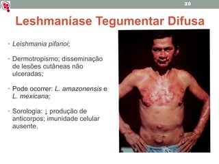 Leishmania pifanoi ; Dermotropismo; disseminação de lesões cutâneas não ulceradas; Pode ocorrer:  L. amazonensis  e  L. mexicana; Sorologia: ↓ produção de anticorpos; imunidade celular ausente. Leshmaníase Tegumentar Difusa 