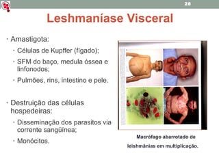 Amastigota: Células de Kupffer (fígado); SFM do baço, medula óssea e linfonodos; Pulmões, rins, intestino e pele. Destruição das células hospedeiras: Disseminação dos parasitos via corrente sangüínea; Monócitos. Leshmaníase Visceral Macrófago abarrotado de leishmânias em multiplicação. 