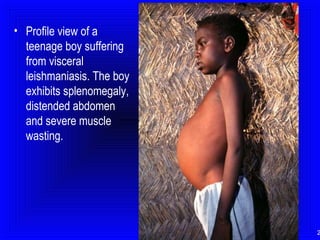 • Profile view of a
teenage boy suffering
from visceral
leishmaniasis. The boy
exhibits splenomegaly,
distended abdomen
and severe muscle
wasting.

2

 