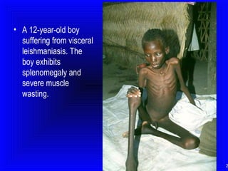• A 12-year-old boy
suffering from visceral
leishmaniasis. The
boy exhibits
splenomegaly and
severe muscle
wasting.

2

 