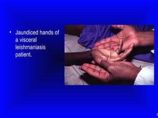 • Jaundiced hands of
a visceral
leishmaniasis
patient.

2

 
