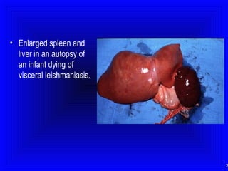 • Enlarged spleen and
liver in an autopsy of
an infant dying of
visceral leishmaniasis.

2

 