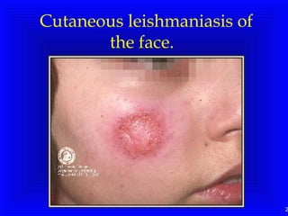 Cutaneous leishmaniasis of
the face. 

2

 