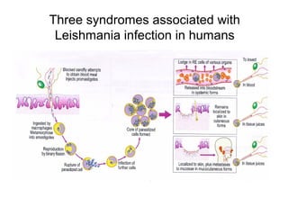 Three syndromes associated with
Leishmania infection in humans
 