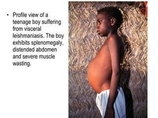 • Profile view of a
teenage boy suffering
from visceral
leishmaniasis. The boy
exhibits splenomegaly,
distended abdomen
and severe muscle
wasting.
 