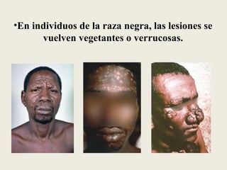 •En individuos de la raza negra, las lesiones se
      vuelven vegetantes o verrucosas.
 