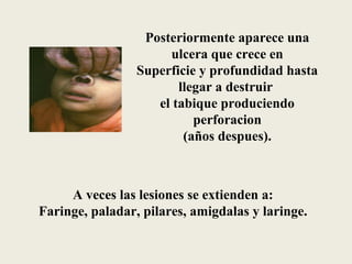 Posteriormente aparece una
                      ulcera que crece en
                 Superficie y profundidad hasta
                        llegar a destruir
                    el tabique produciendo
                           perforacion
                         (años despues).



     A veces las lesiones se extienden a:
Faringe, paladar, pilares, amigdalas y laringe.
 