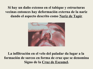Si hay un daño extenso en el tabique y estructuras
vecinas entonces hay deformación externa de la nariz
   dando el aspecto descrito como Nariz de Tapir.




  La infiltración en el velo del paladar da lugar a la
formación de surcos en forma de cruz que se denomina
             Signo de la Cruz de Escomel.
 