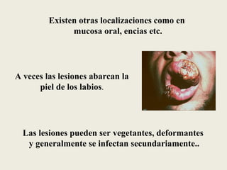 Existen otras localizaciones como en
               mucosa oral, encias etc.




A veces las lesiones abarcan la
      piel de los labios.




  Las lesiones pueden ser vegetantes, deformantes
   y generalmente se infectan secundariamente..
 