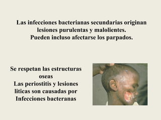 Las infecciones bacterianas secundarias originan
          lesiones purulentas y malolientes.
       Pueden incluso afectarse los parpados.




Se respetan las estructuras
           oseas
 Las periostitis y lesiones
 liticas son causadas por
  Infecciones bacteranas
 