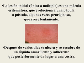 •La lesión inicial (única o múltiple) es una mácula
    eritematosa, que evoluciona a una pápula
       o pústula, algunas veces pruriginosa,
               que crece lentamente.




•Después de varios días se ulcera y se recubre de
      un líquido amarillento y adherente
   que posteriormente da lugar a una costra.
 