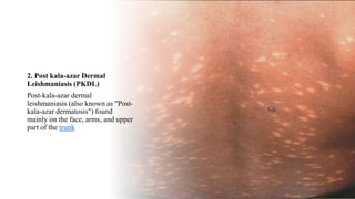2. Post kala-azar Dermal
Leishmaniasis (PKDL)
Post-kala-azar dermal
leishmaniasis (also known as "Post-
kala-azar dermatosis") found
mainly on the face, arms, and upper
part of the trunk
 