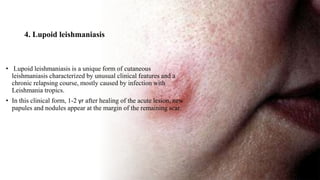 4. Lupoid leishmaniasis
• Lupoid leishmaniasis is a unique form of cutaneous
leishmaniasis characterized by unusual clinical features and a
chronic relapsing course, mostly caused by infection with
Leishmania tropics.
• In this clinical form, 1-2 yr after healing of the acute lesion, new
papules and nodules appear at the margin of the remaining scar.
 