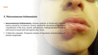 5. Mucocutaneous leishmaniasis
• mucocutaneous leishmaniasis a disease endemic in South and Central A
merica caused by Leishmania Vannia, marked by ulceration of the mucou
s membranes of the nose, mouth, and pharynx; widespread destruction of
soft tissues in nasal and oral regions may occur.
• Called also espundia. Treatment consists of injections of pentavalent anti
monial compounds.
 
