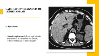 LABORATORY DIAGNOSIS OF
LEISHMANIASIS:
a) Specimens:
• Splenic aspiration-Splenic aspiration is
the removal of fluid from the spleen,
often with the use of a fine-needle
 