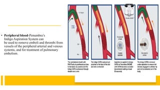 • Peripheral blood-Penumbra’s
Indigo Aspiration System can
be used to remove emboli and thrombi from
vessels of the peripheral arterial and venous
systems, and for treatment of pulmonary
embolism.
 