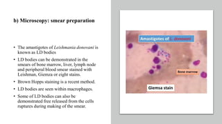 b) Microscopy: smear preparation
• The amastigotes of Leishmania donovani is
known as LD bodies
• LD bodies can be demonstrated in the
smears of bone marrow, liver, lymph node
and peripheral blood smear stained with
Leishman, Giemza or eight stains.
• Brown Hopps staining is a recent method.
• LD bodies are seen within macrophages.
• Some of LD bodies can also be
demonstrated free released from the cells
ruptures during making of the smear.
 