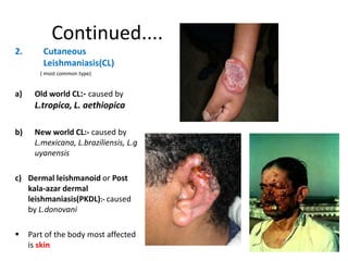 Continued....
2.

Cutaneous
Leishmaniasis(CL)
( most common type)

a)

Old world CL:- caused by

L.tropica, L. aethiopica
b)

New world CL:- caused by
L.mexicana, L.braziliensis, L.g
uyanensis

c) Dermal leishmanoid or Post
kala-azar dermal
leishmaniasis(PKDL):- caused
by L.donovani


Part of the body most affected
is skin

 