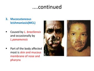 ....continued
3. Mucocutaneous
leishmaniasis(MCL)


Caused by L. braziliensis
and occasionally by
L.panamensis



Part of the body affected
most is skin and mucous
membrane of nose and
pharynx

 
