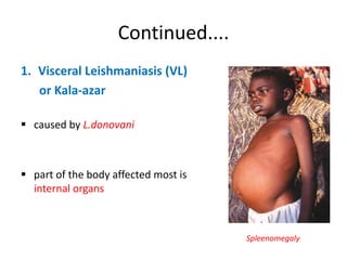 Continued....
1. Visceral Leishmaniasis (VL)
or Kala-azar
 caused by L.donovani
 part of the body affected most is
internal organs
Spleenomegaly
 