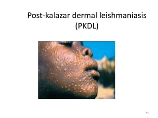 Post-kalazar dermal leishmaniasis 
(PKDL) 
45 
 