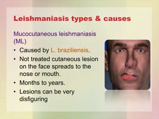 Leishmaniasis types & causes

Mucocutaneous leishmaniasis
(ML)
• Caused by L. braziliensis.
• Not treated cutaneous lesion
  on the face spreads to the
  nose or mouth.
• Months to years.
• Lesions can be very
  disfiguring
 