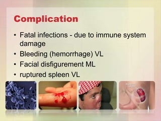 Complication
• Fatal infections - due to immune system
  damage
• Bleeding (hemorrhage) VL
• Facial disfigurement ML
• ruptured spleen VL
 