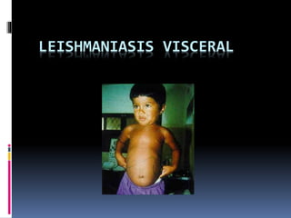 LEISHMANIASIS VISCERAL
 