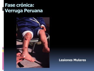 Fase crónica:
Verruga Peruana
Lesiones Mulares
 
