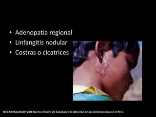 • Adenopatía regional
• Linfangitis nodular
• Costras o cicatrices
NTS-MINSA/DGSP-V.01 Norma Técnica de Salud para la Atención de las Leishmaniosis en el Perú
 