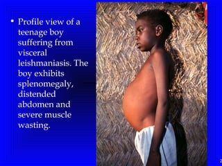 2
• Profile view of a
teenage boy
suffering from
visceral
leishmaniasis. The
boy exhibits
splenomegaly,
distended
abdomen and
severe muscle
wasting. 
 