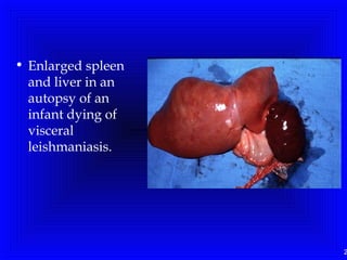 2
• Enlarged spleen
and liver in an
autopsy of an
infant dying of
visceral
leishmaniasis.
 