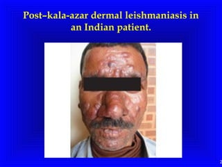 2
Post–kala-azar dermal leishmaniasis in
an Indian patient.
 