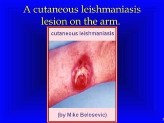 3
A cutaneous leishmaniasis
lesion on the arm.
 