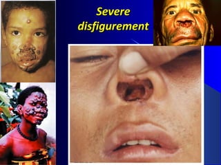 SevereSevere
disfigurementdisfigurement
 