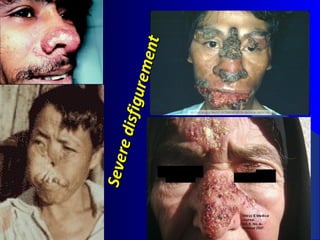 Severedisfigurement
Severedisfigurement
 