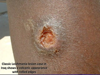 Classic Leishmania lesion case inClassic Leishmania lesion case in
Iraq shows a volcanic appearanceIraq shows a volcanic appearance
with rolled edgeswith rolled edges
 