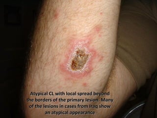 Atypical CL with local spread beyondAtypical CL with local spread beyond
the borders of the primary lesion. Manythe borders of the primary lesion. Many
of the lesions in cases from Iraq showof the lesions in cases from Iraq show
an atypical appearancean atypical appearance
 